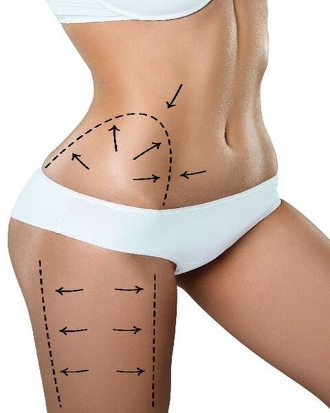 tummy tuck2(1)