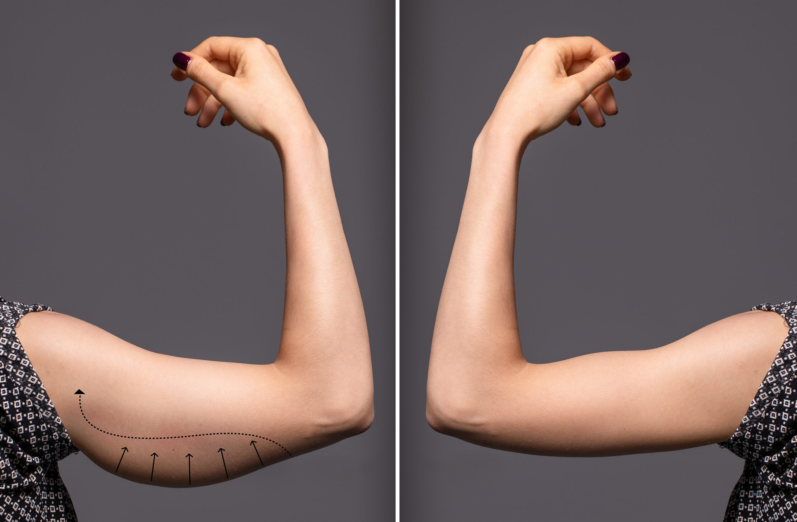 Woman arms with bat wings, comparison between before and after b