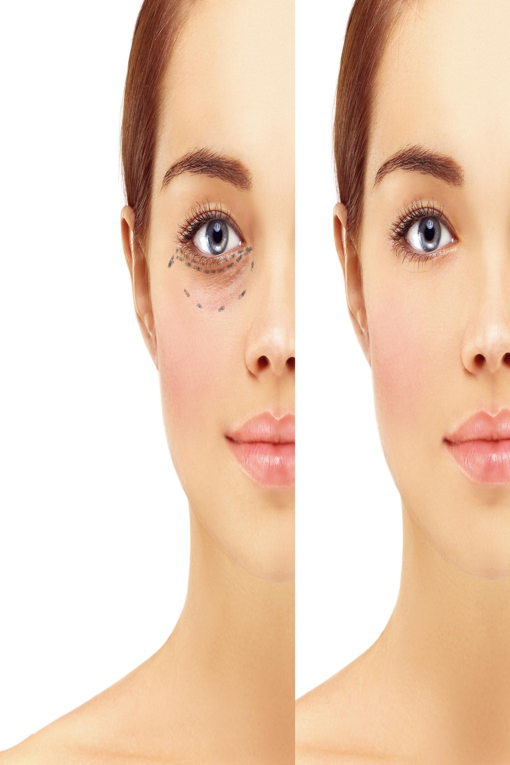 resized_Blepharoplasty sub2