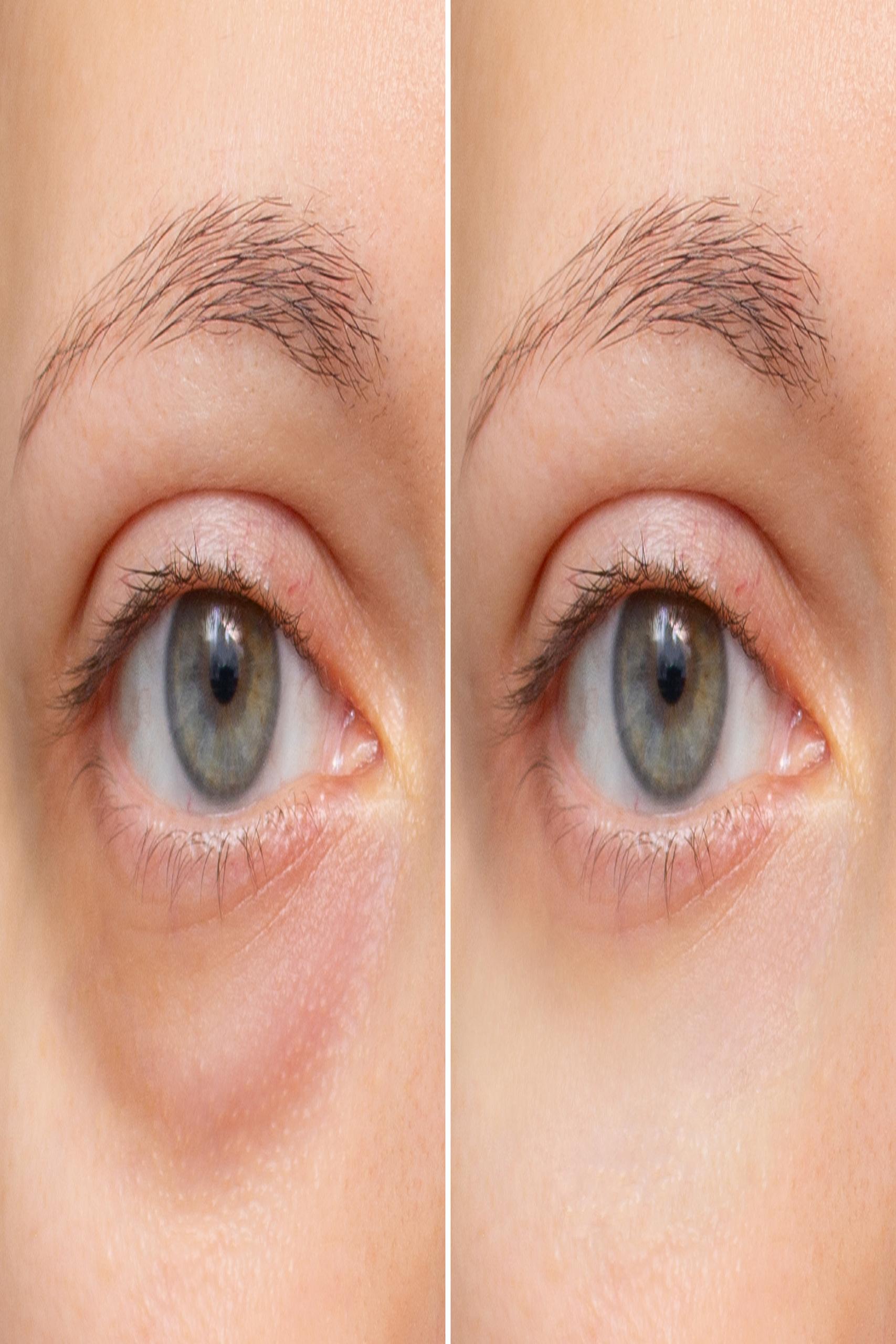 resized_Blepharoplasty sub4