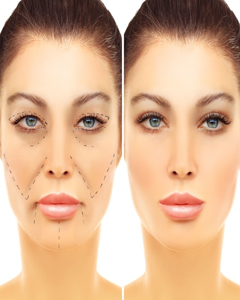 resized_Facelift 29378